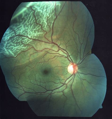 Rhegmatogenous Retinal Detachment Retina Image Bank