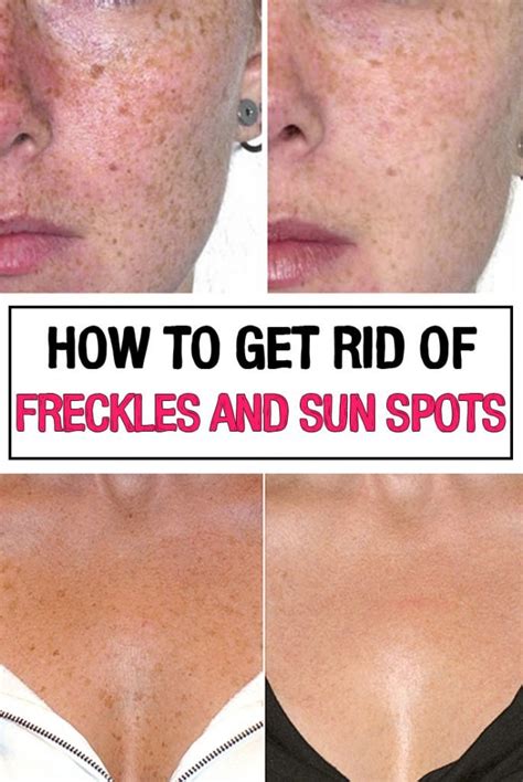 How To Get Rid Of Freckles And Sun Spots Iwomenhacks