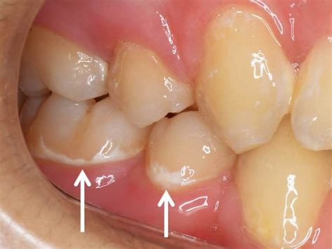 歯列矯正中は、虫歯に用心を！ブラケットの周りは虫歯になりやすい！ 神田の歯医者｜神田デンタルケアクリニック
