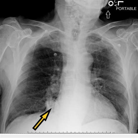 Chest X Ray Showing Cardiomegaly With No Acute Lung Infiltrates
