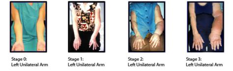 Stages Of Lymphedema