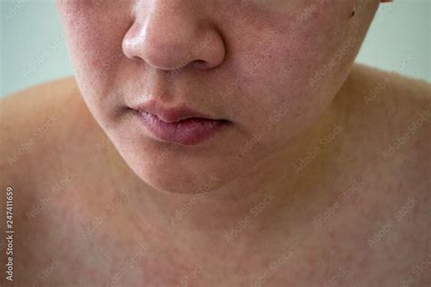 An Exanthem Is A Rash Or Eruption On The Skin Viral Means That The