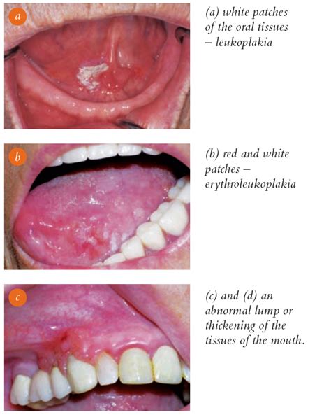Warning Signs Of Oral Cancer