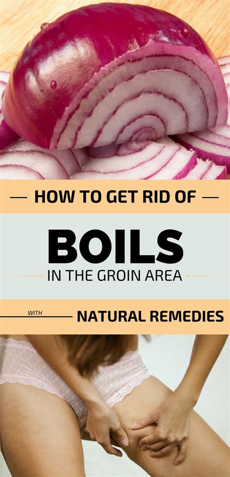 The groin is the superficial area where the trunk and the legs meet; How To Get Rid Of Boils In The Groin Area With Natural ...