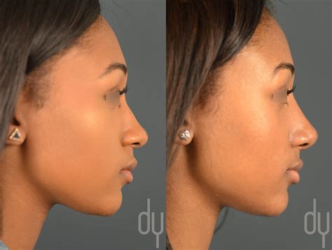 Primary Rhinoplasty Before And After Beverly Hills Facial Plastic Surgery Donald B Yoo M D