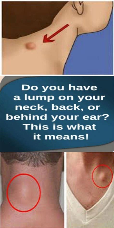 Do You Have A Lump On Your Neck Back Or Behind Your Ear This Is What