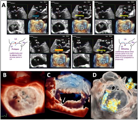 Frontiers Advances In Procedural Echocardiographic Imaging In