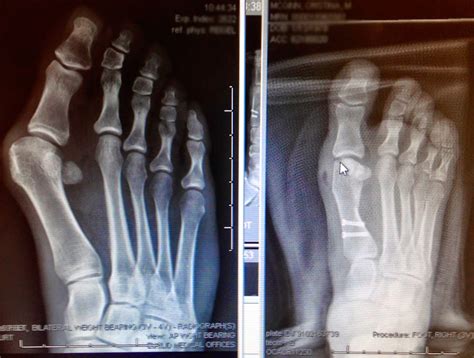 The Bloomin Bunion Bunion Surgery And Recovery Blog Bunion Surgery