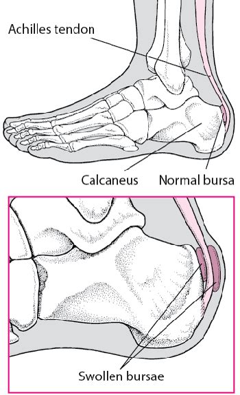 Achilles Tendon Bursitis Bone Joint And Muscle Disorders Msd