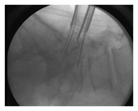 Grade 1 L5 S1 Spondylolisthesis With The Bilateral Pars Defect A