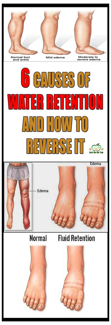 6 Causes Of Water Retention And How To Reverse It Edema Water