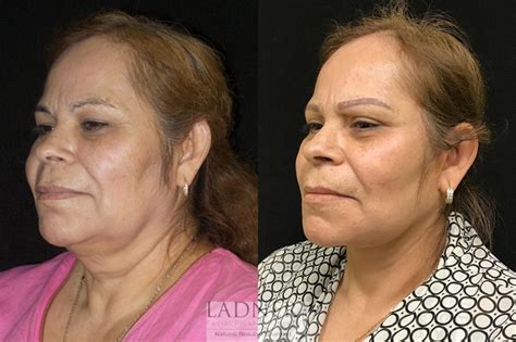 eyelid surgery blepharoplasty before and after pictures case 53 denver co ladner facial
