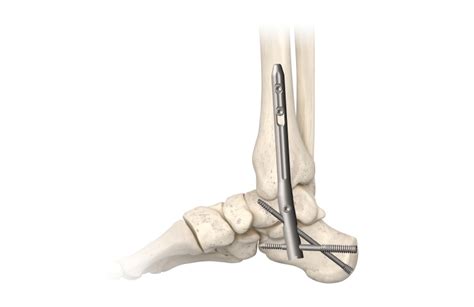 In2bones Launches Triway Ankle Implant Medical Design And Outsourcing