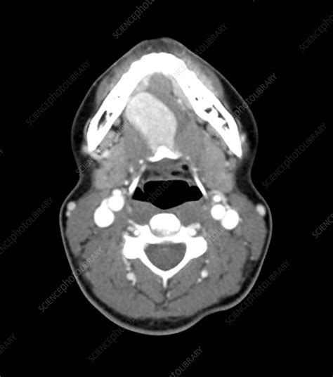 Lingual Thyroid Ct Scan Stock Image C0271857 Science Photo Library