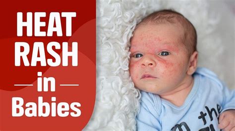 Newborn Baby Face Rash Remedy Newborn Baby
