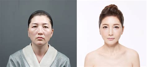 Fotos Antes Y Despu S En La Cirug A Coreana Son Impresionantes Difundir Org