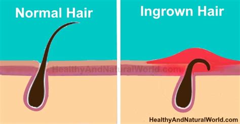 How To Naturally Get Rid Of Ingrown Pubic Hair And Bumps