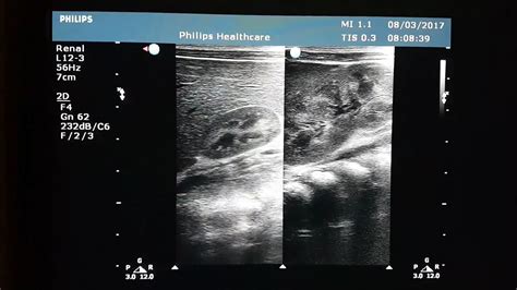 Normal Neonatal Kidney Ultrasound