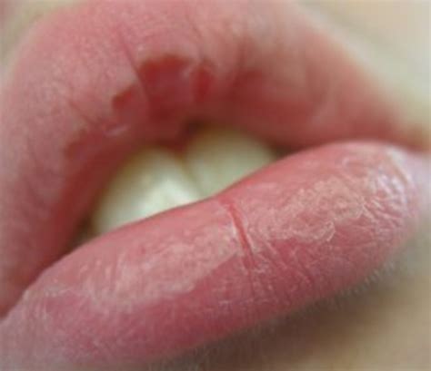 How To Care For Dry Cracked Chapped Lips Hubpages