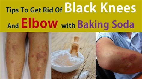 Tips To Get Rid Of Black Knees And Elbow Get Rid Dark Elbows With