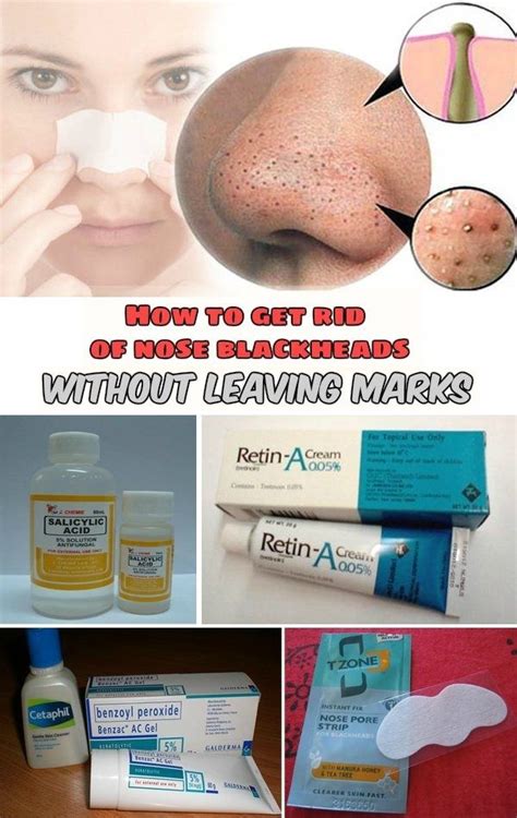 How To Get Rid Of Nose Blackheads Without Leaving Marks Con Imágenes