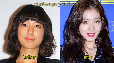 Park Shin Hye Cosmetic Surgery Plastic Surgery Feed