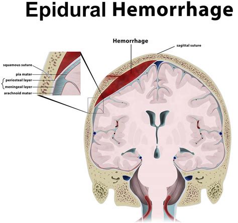 Epidural Hematoma Causes Signs Symptoms Diagnosis And Treatment