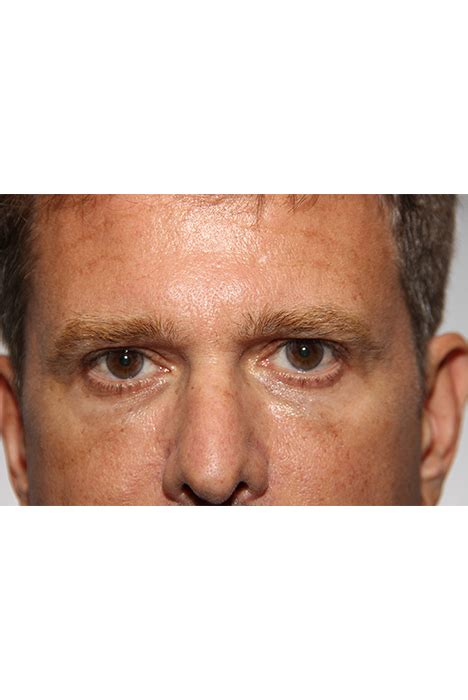 Brow lift before & after pictures. Brow Lift | Solomon Facial Plastic, Toronto