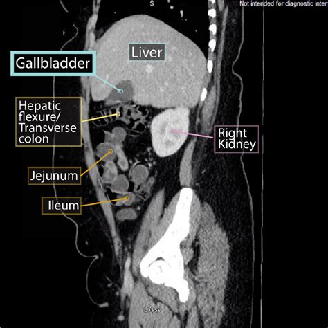 Gallbladder Imaging Gross Anatomy Flashcards Ditki Medical And