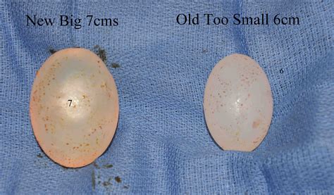 Large Testicle Inplants Dr Barry Eppley Indianapolis Explore Plastic