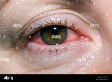 close up de los ojos rojos en una paciente femenina de 47 años con la epiescleritis una