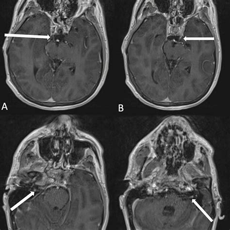Axial Brain Mri Contrast Enhanced T1 Weighted Using Cranial Nerve