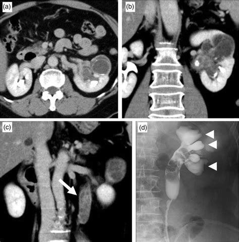 A Axial And B C Coronal Excretory Phase Contrast Ct Showing A