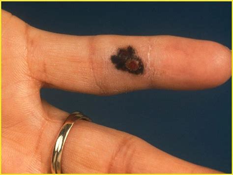 Pin On Routinely Examine Skin