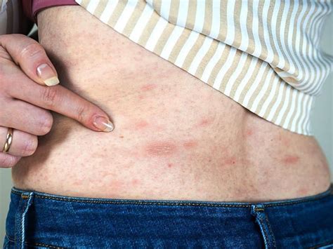 Acute And Chronic Hives And Rashes Causes And Treatments Brynna