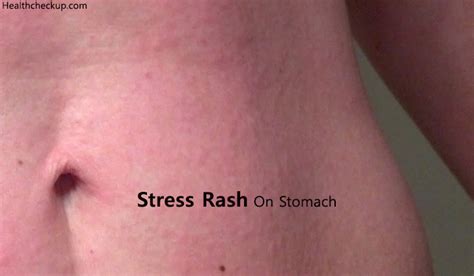 Stress Rash On Stomach Causes Symptomstreatment Health Checkup