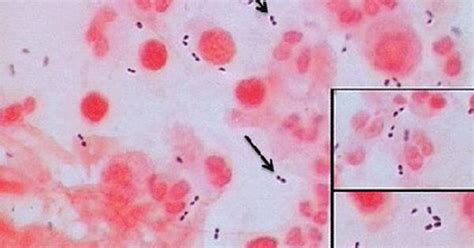 Csf Gram Stain S Pneumo Gram Positive Diplococci Pathology Review Pinterest Microbiology