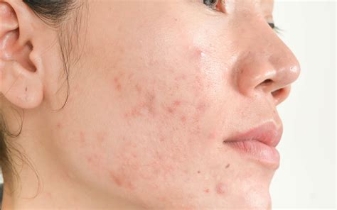 What Is Subclinical Acne And How To Treat It Easy Tips Guide