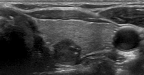 In addition, it helps to accurately determine the location of the sample by. Transverse ultrasound image of thyroid nodules. Ultrasound ...