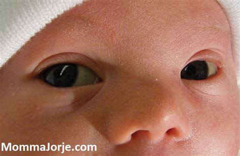 Epicanthal folds are folds in the inner corner of the eye secondary to a flat mid face or a smaller than usual nasal bone. Momma Jorje: I did not Birth a Syndrome
