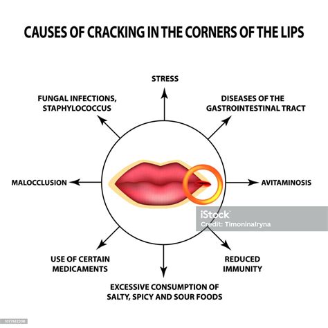 Causes Of Lip Cracks Cracks In The Corners Of The Mouth Infographics