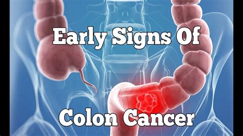 Blood In Stool Colon Cancer Symptoms Images