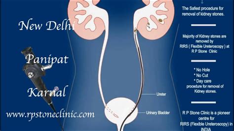 Animation Of Kidney Stone Treatment By Rirs Flexible Ureteroscopy Youtube