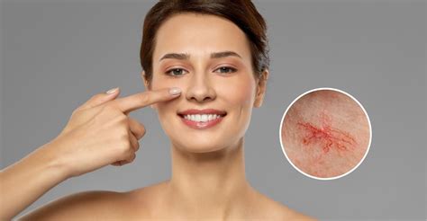 Facial Spider Veins And Broken Capillaries San Diego Cardiac Vein And