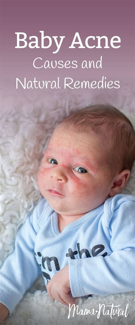 Baby Acne What Causes It And How To Treat Naturally Baby Acne Baby