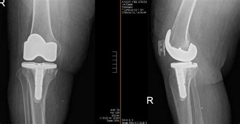 Right Total Knee Arthroplasty Dr Nakul Karkare Ny Usa