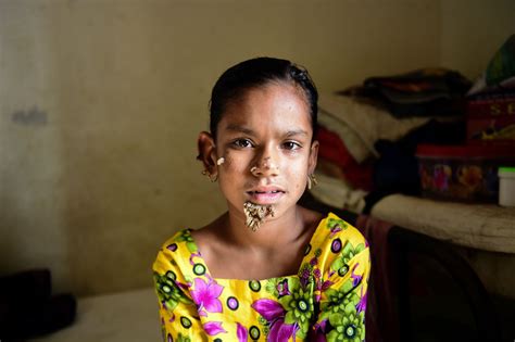 Bangladeshi Girl 10 May Be First Female With ‘tree Man Syndrome