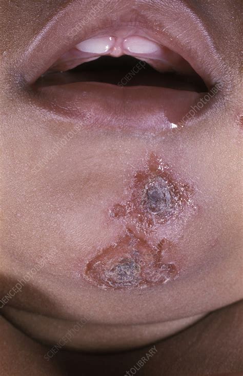 Impetigo Skin Infection Stock Image M1800105 Science Photo Library
