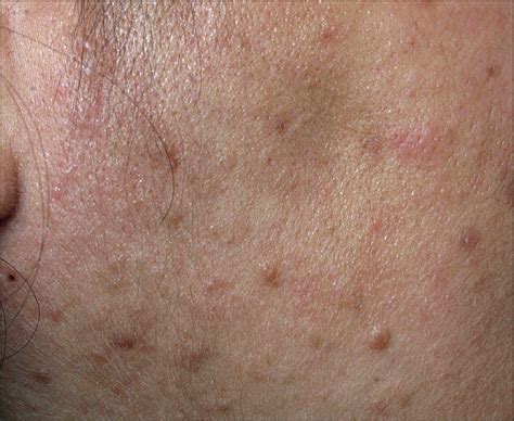 Multiple Painful Skin Colored Papules—quiz Case Dermatology Jama