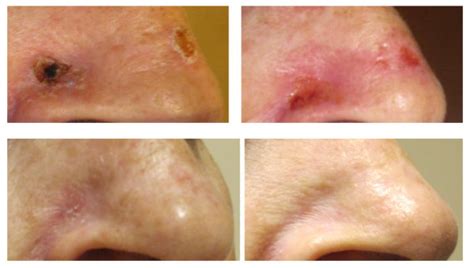 Ebt Treatment Of Basal Cell Carcinoma Photo At Pretreatment Top